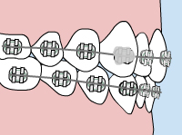 Illustration of a loose orthodontic appliance 