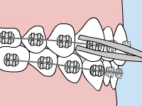 Illustration of metal braces with a loose wire 