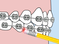 Illustration of a patient using a pencil to fix the wire on their braces